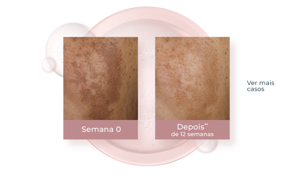 Thiamidol: O Ingrediente Anti-Manchas Mais Efetivo | Eucerin®